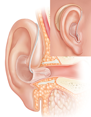 Hearing Aids: Uses & How They Work