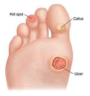 Sole of foot showing callus, hot spot, and ulcer.