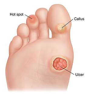 Painful spot on on sale sole of foot