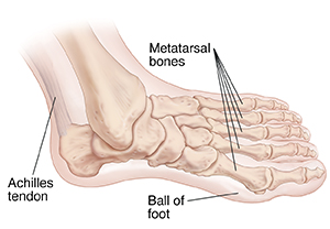 What Is Metatarsalgia | Saint Luke's Health System