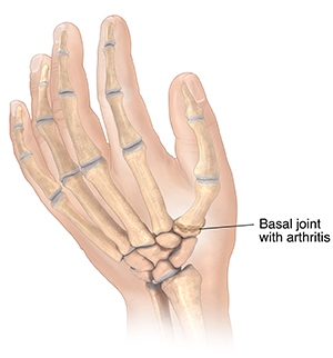 Hand Osteoarthritis Is Worse When It Affects Your Fingers and Base of Thumb