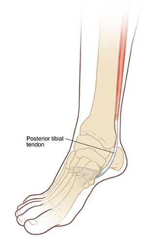 Three-quarter view of lower leg and foot showing bones and  posterior tibial tendon. 