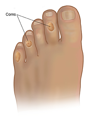 What Are Corns and Calluses Saint Luke s Health System