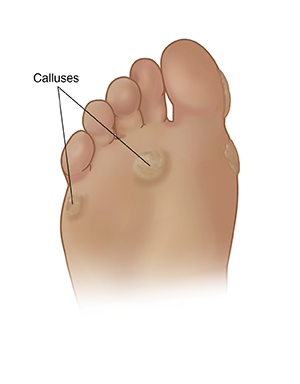 Callous on cheap bottom of foot