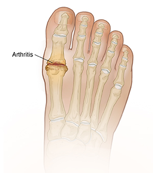 What is Arthritis?