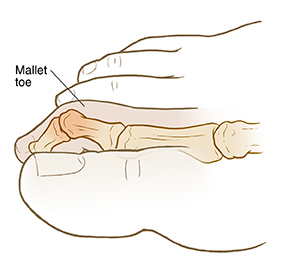 What are corns and hammer, claw, and mallet toes?