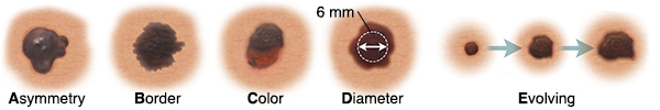 Mole with asymmetrical shape. Mole with uneven, blurry borders. Mole with dark and light spots. Mole with 6 mm measurement across diameter. Three moles showing changes in mole over time.