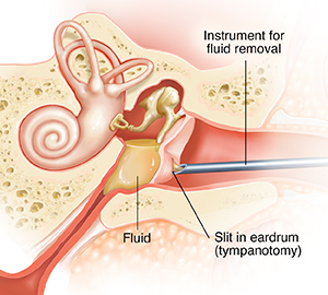 Ear Tube (Tympanostomy) Procedure | Saint Luke's Health System