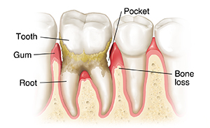 Teeth in gums showing advanced periodontitis.