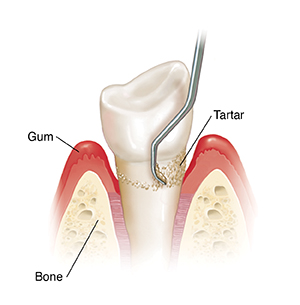 What Is Scaling and Root Planing? | Saint Luke's Health System