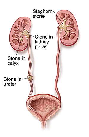 Understanding Kidney Stones