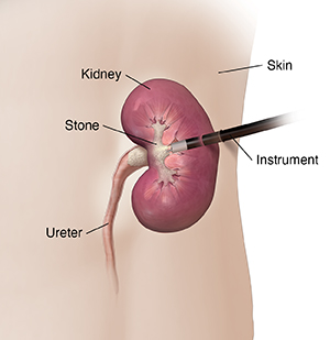 Front view of left flank showing kidney with stone. Instrument is inserted through skin into kidney to break up stone.