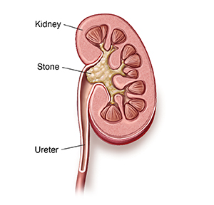 Removal of deals kidney stones