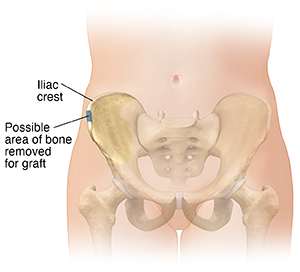 Having a Bone Graft  Saint Luke's Health System