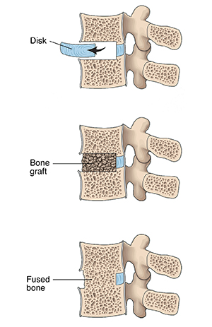 Having a Bone Graft  Saint Luke's Health System