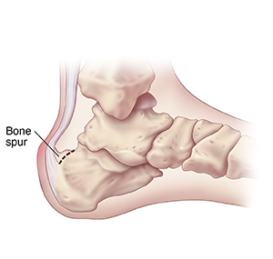 Bone spur on hot sale achilles tendon treatments