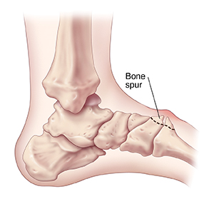 Foot Surgery: Bone Spurs  Saint Luke's Health System