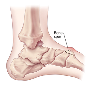 Bone spur bottom hot sale of toe