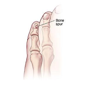 Bone on sale spur foot