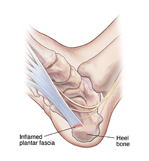 Plantar Fasciitis Surgery – Heel Spur Removal