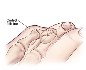 Foot Surgery: Curled Fifth Toe