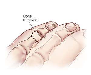 Top view of curled fifth toe with dotted line showing bone removed for  derotation arthroplasty.