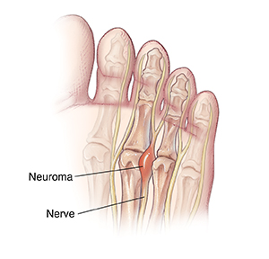 Pinky Toe Pinch Callus: Toe Pinch Callus