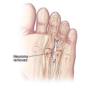 https://api.kramesstaywell.com/Content/6066ca30-310a-4170-b001-a4ab013d61fd/medical-illustrations/Images/84865_2