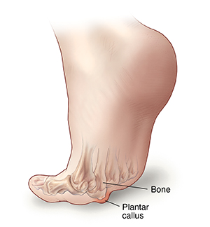 Painful callus on bottom of deals foot