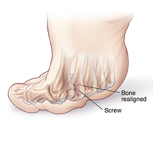 Callus removal from feet: balls of feet 