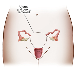 Types of Laparoscopic Hysterectomy