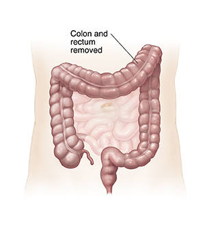 J-Pouch: What It Is, Surgery & Complications