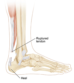 Achilles Tendon Rupture | Saint Luke's Health System