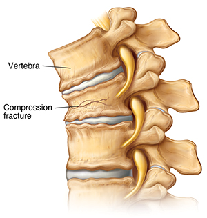 Compression Fracture Treatment, Causes, & Symptoms
