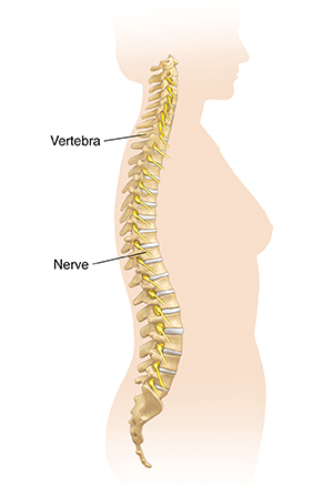 Your Scoliosis Brace  Saint Luke's Health System