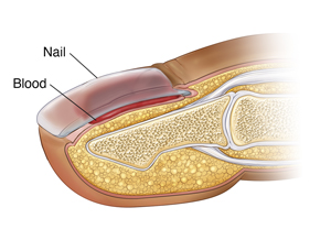 Dried Blood Under Fingernail: What to do