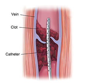 CLOT-BUSTER  English meaning - Cambridge Dictionary