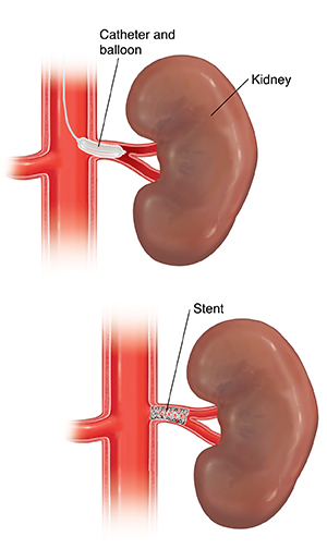 stint medical