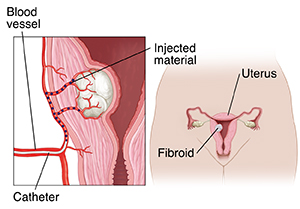 Vaginal Bleeding, Uterine Fibroids