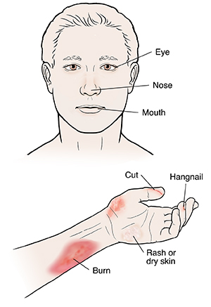 Dermatitis rash viral disease with immunodeficiency on body of