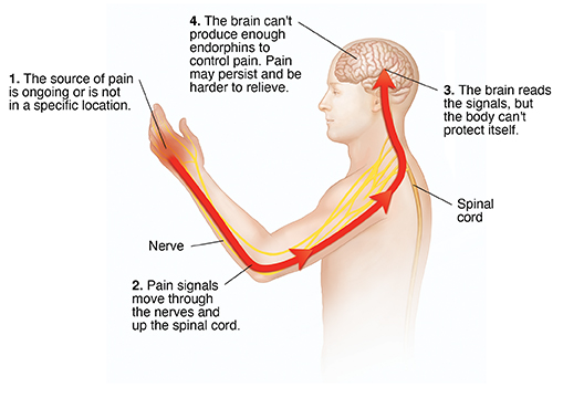 Understanding Chronic Pain  Saint Luke's Health System