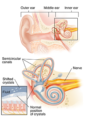 Cross section of ear showing outer, middle, and inner ear with closeup of cochlea. Inset shows cells and shifted crystals.