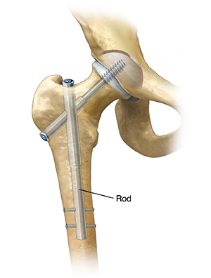Hip Fracture Surgery: Types
