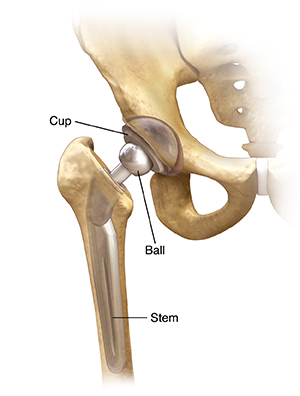 Front view of hip joint with total prosthesis in place.