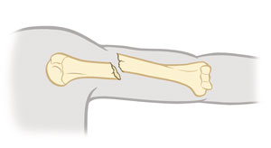 Common Types of Fractures Saint Luke s Health System