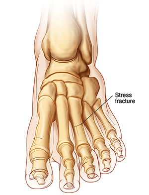 Stress Fracture Causes Symptoms ampamp Treatment  The Feet People Podiatry