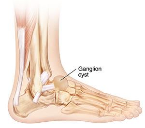 Bony growth on top clearance of foot