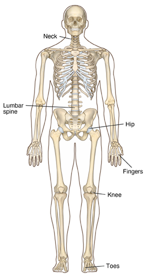 Osteoarthritis: Common Sites