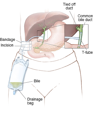 Discharge Instructions: Biliary Catheter