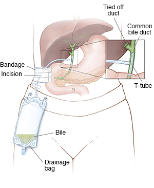 Surgical Drain Care: Care Instructions